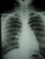 X-ray has been widely used in medical diagnosis.